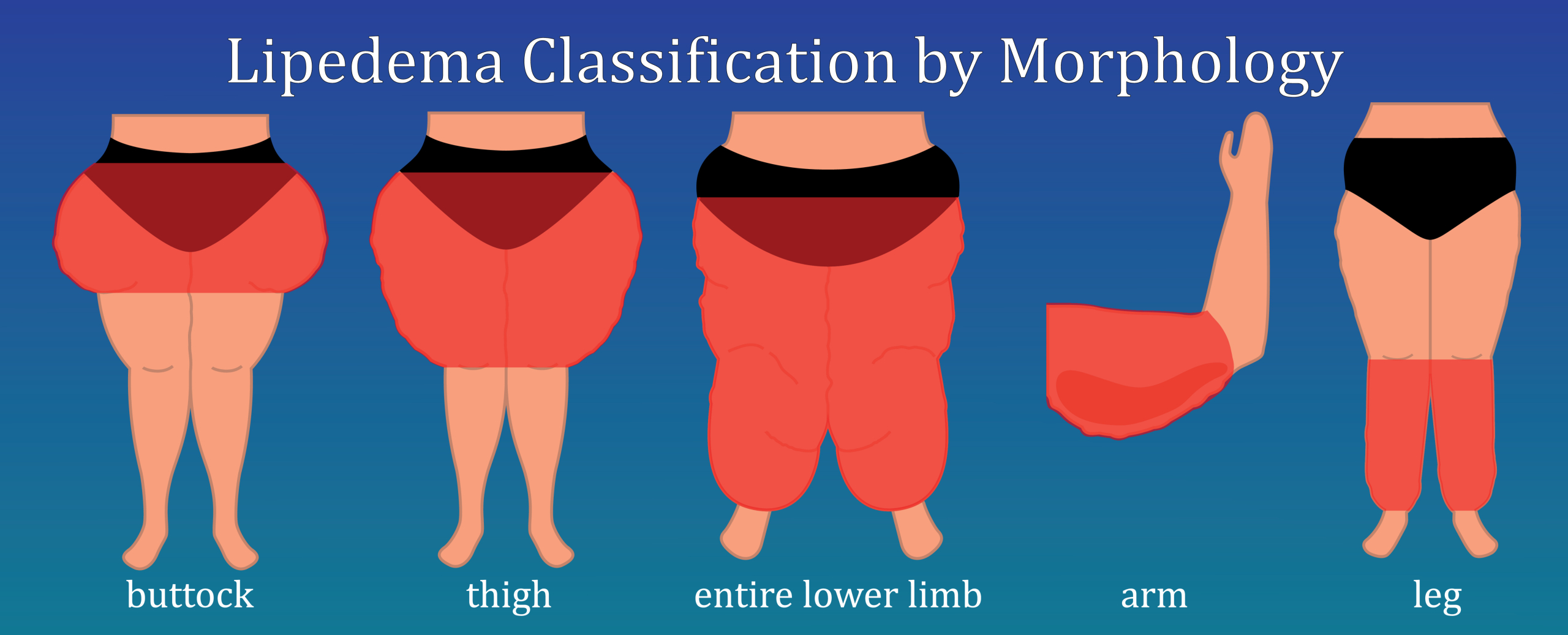 lipedema classificació cos